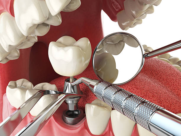 Best Emergency Tooth Extraction in Duncan Falls, OH